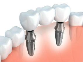 Harbrouck Heights Dentist | Bergen County | dental implants | Robert L. Leung DDS
