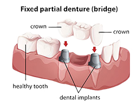 Harbrouck Heights | Bergen County Dentist | dental bridges  | Robert L. Leung DDS
