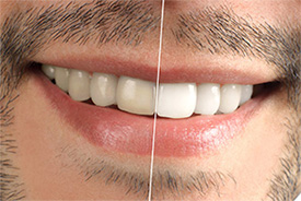 Harbrouck Heights Dentist | Bergen County | teeth whitening | Robert L. Leung DDS