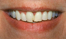 Harbrouck Heights Cosmetic Dentist | CEREC veneers | Bergen County | Robert L. Leung DDS